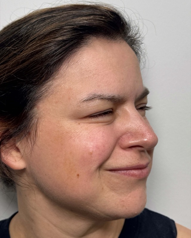 Botox Before & After Image