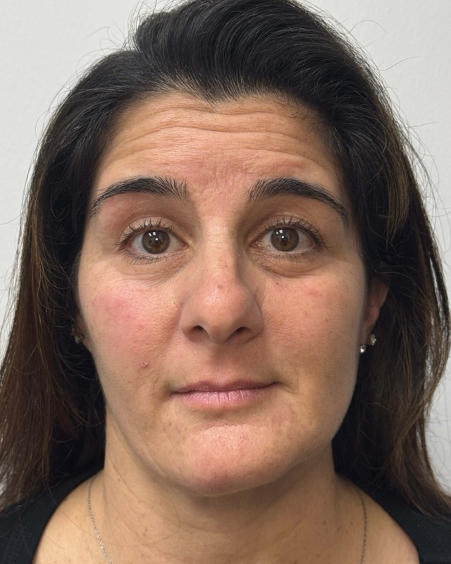 Botox Before & After Image