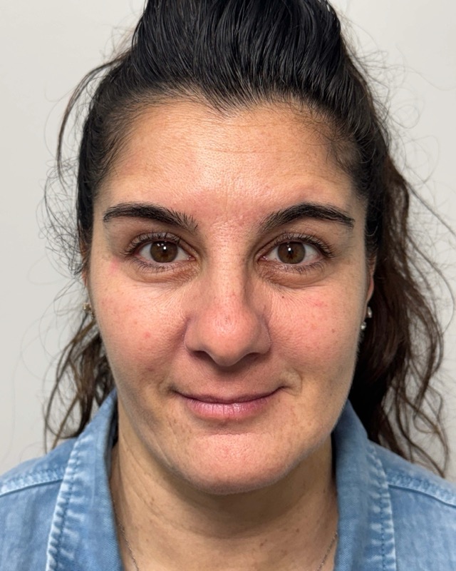 Botox Before & After Image