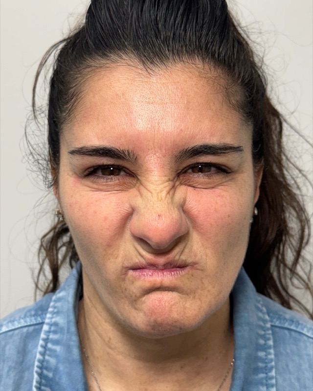 Botox Before & After Image