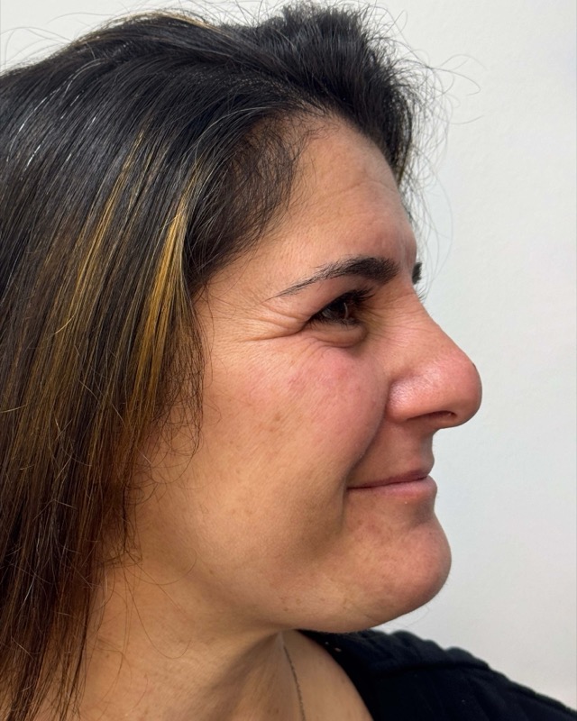 Botox Before & After Image