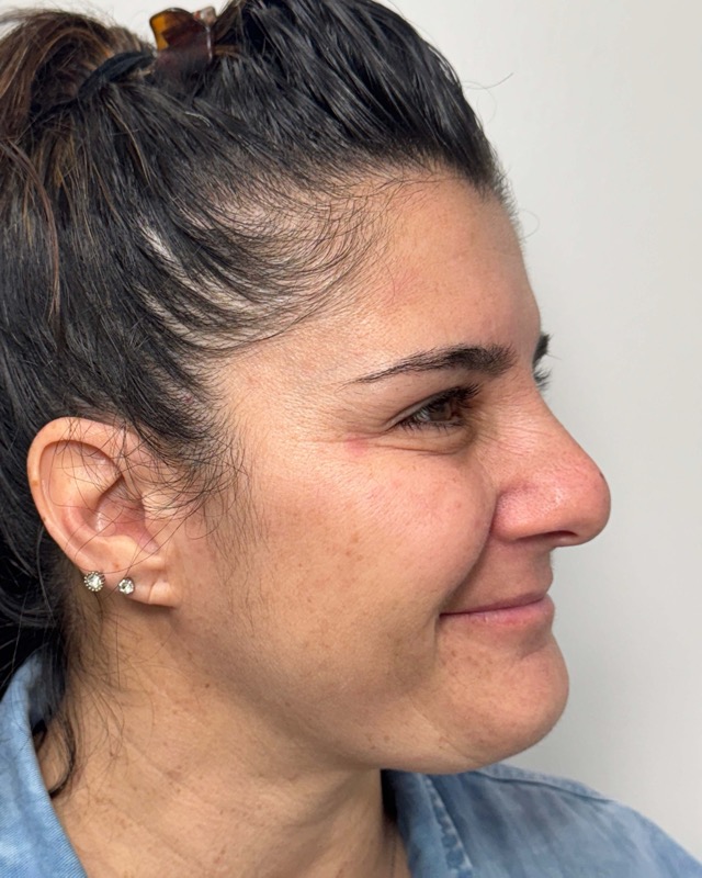 Botox Before & After Image