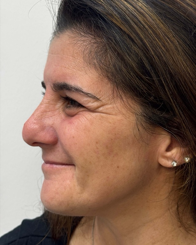 Botox Before & After Image