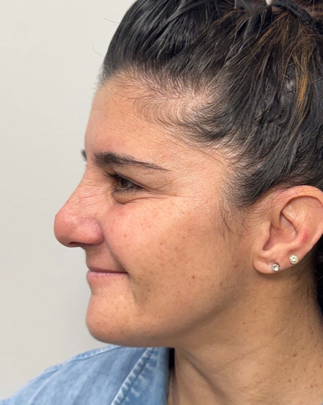 Botox Before & After Image