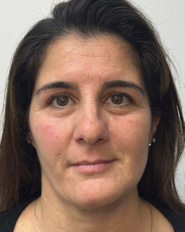 Botox Before & After Image