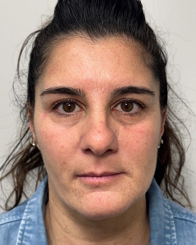 Botox Before & After Image