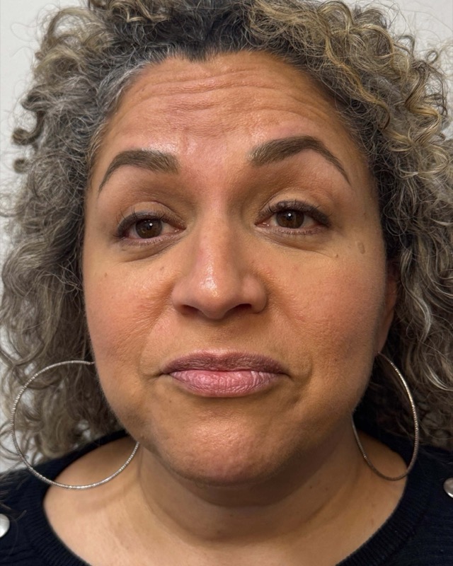 Botox Before & After Image