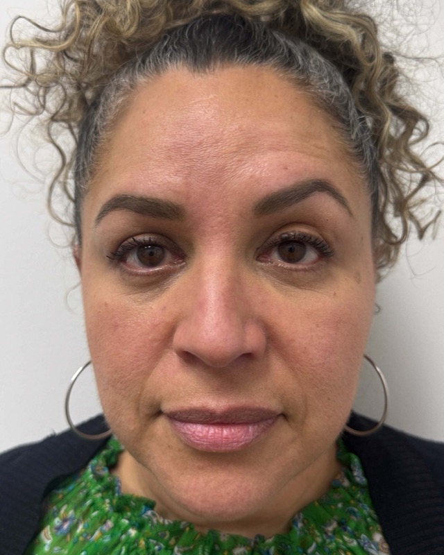 Botox Before & After Image