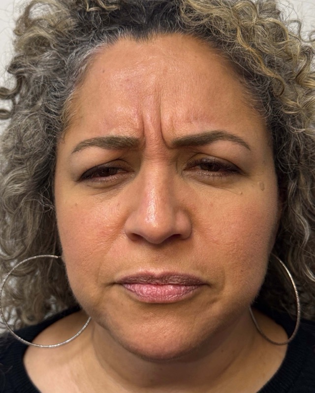 Botox Before & After Image