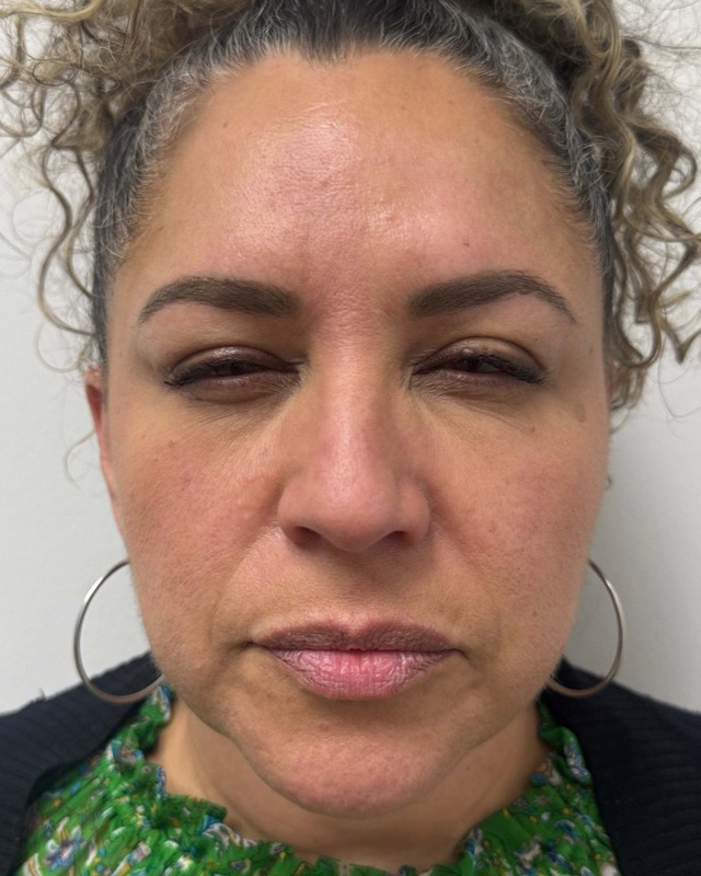 Botox Before & After Image