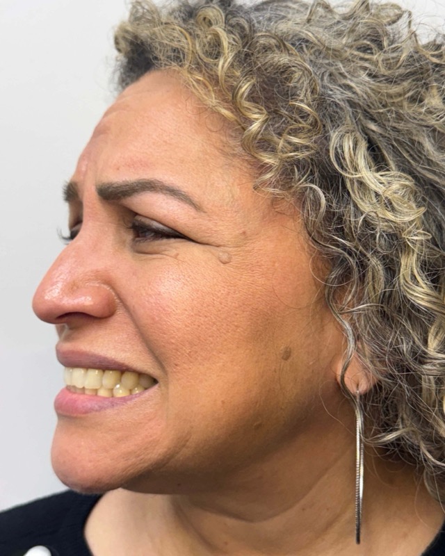 Botox Before & After Image