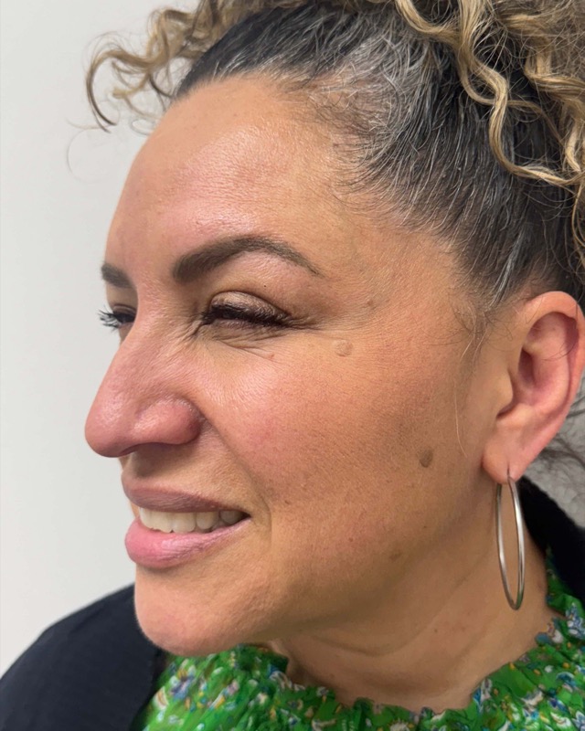 Botox Before & After Image