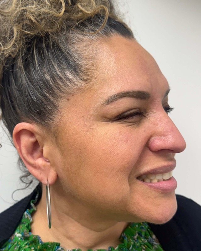 Botox Before & After Image