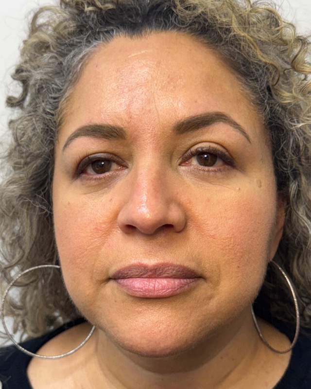 Botox Before & After Image