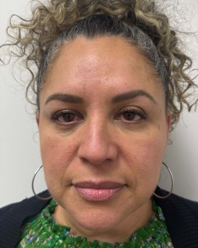 Botox Before & After Image