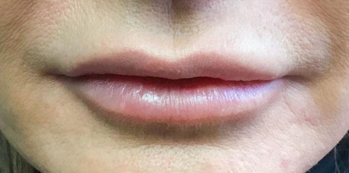Sculptra Before & After Image