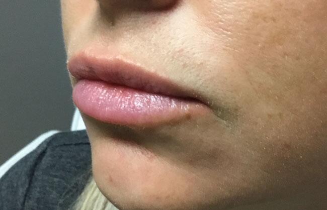 Juvederm Before & After Image