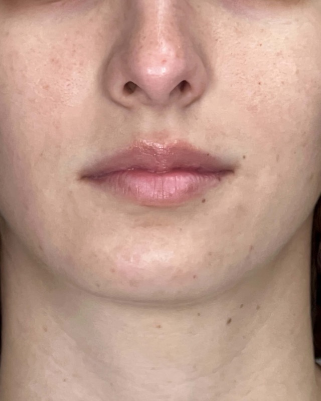 Juvederm Before & After Image