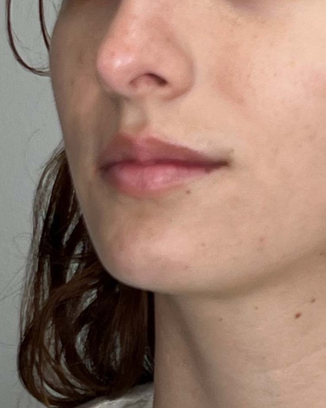 Juvederm Before & After Image