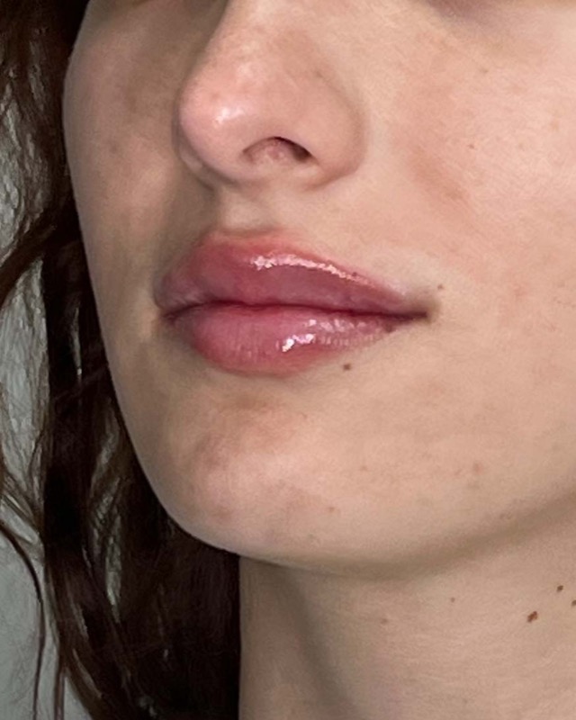 Juvederm Before & After Image