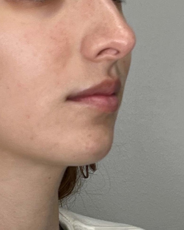 Juvederm Before & After Image