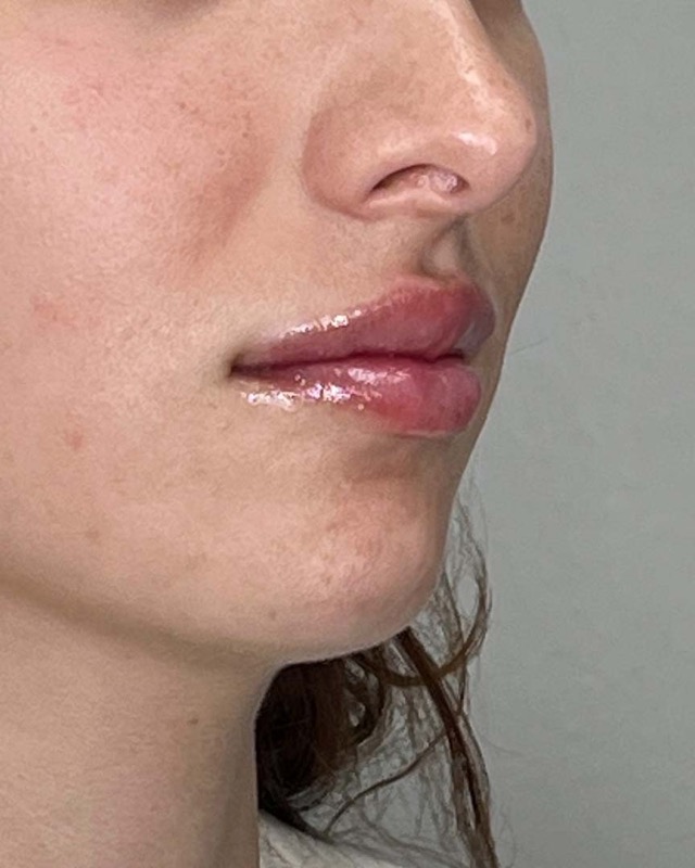 Juvederm Before & After Image