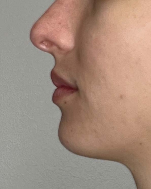 Juvederm Before & After Image