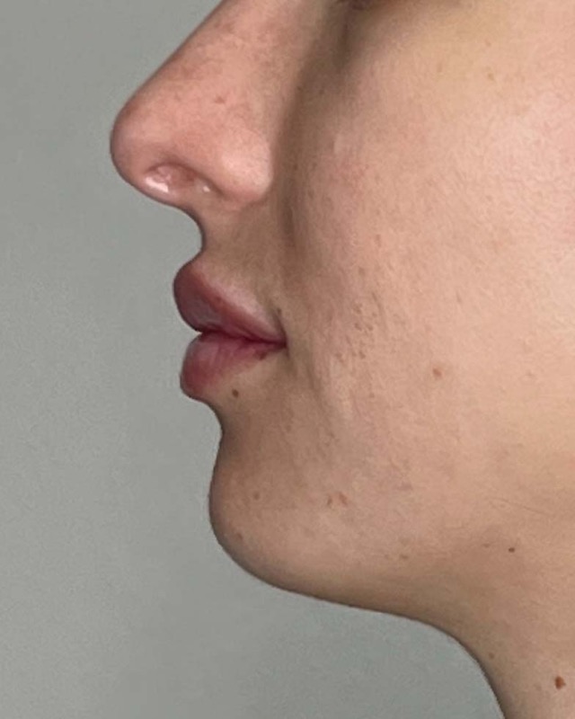 Juvederm Before & After Image