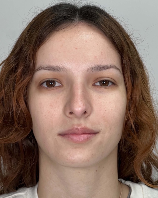 Juvederm Before & After Image