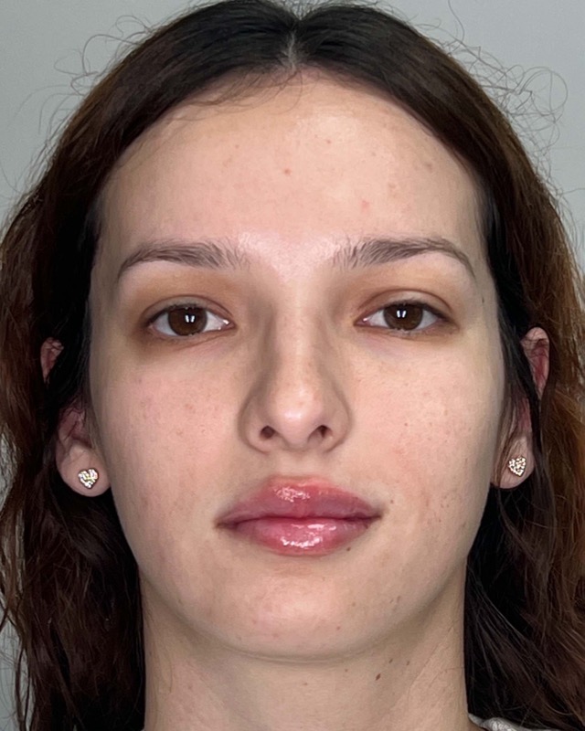 Juvederm Before & After Image