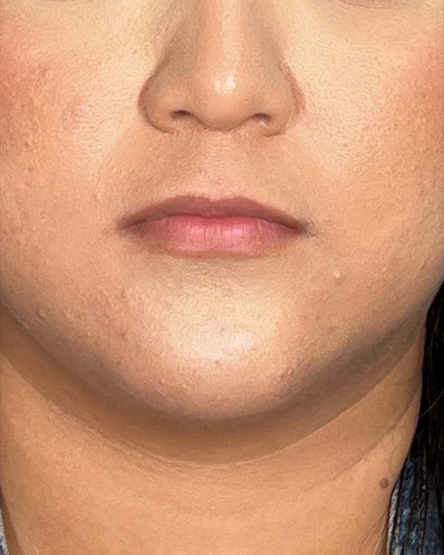 Juvederm Before & After Image