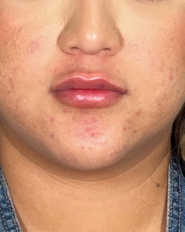 Juvederm Before & After Image