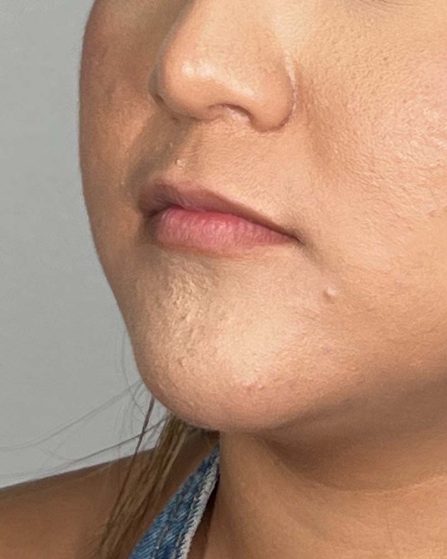 Juvederm Before & After Image