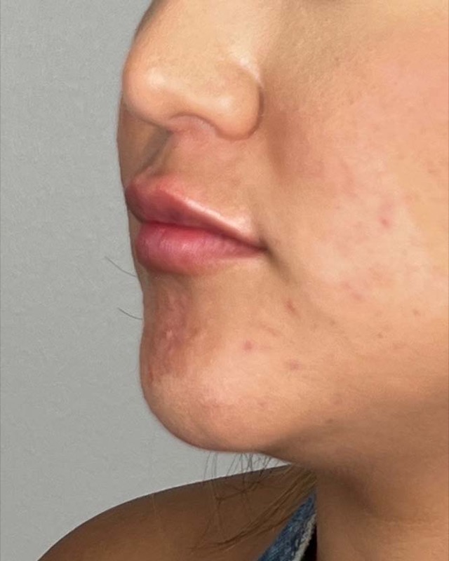 Juvederm Before & After Image