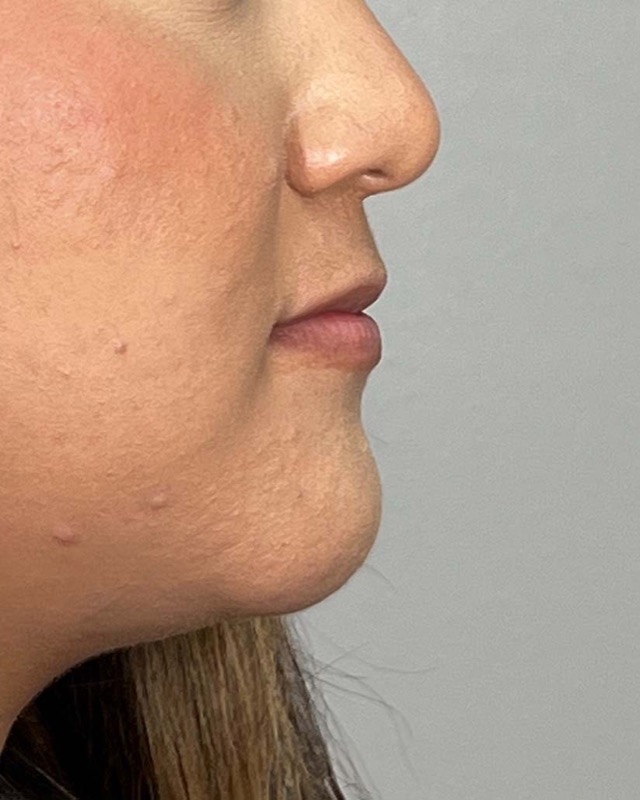 Juvederm Before & After Image