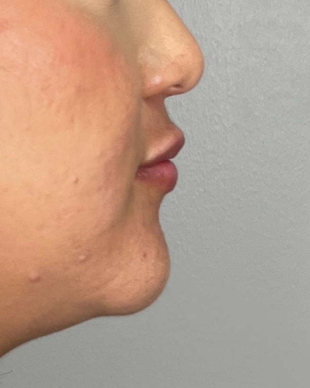 Juvederm Before & After Image
