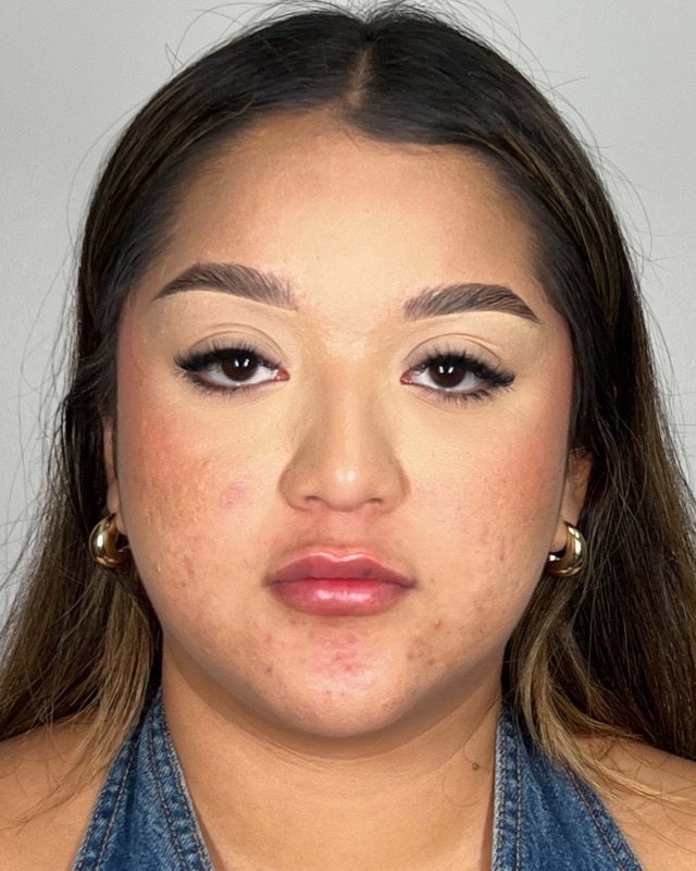 Juvederm Before & After Image