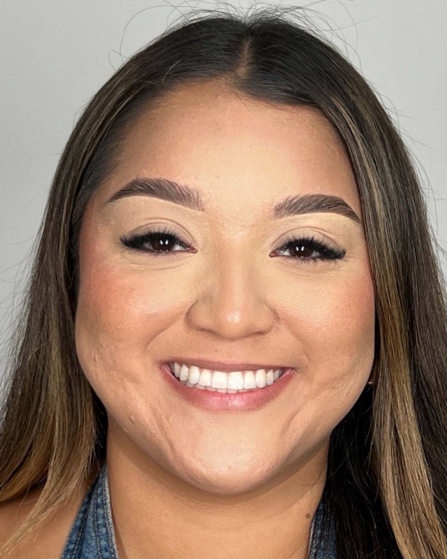 Juvederm Before & After Image