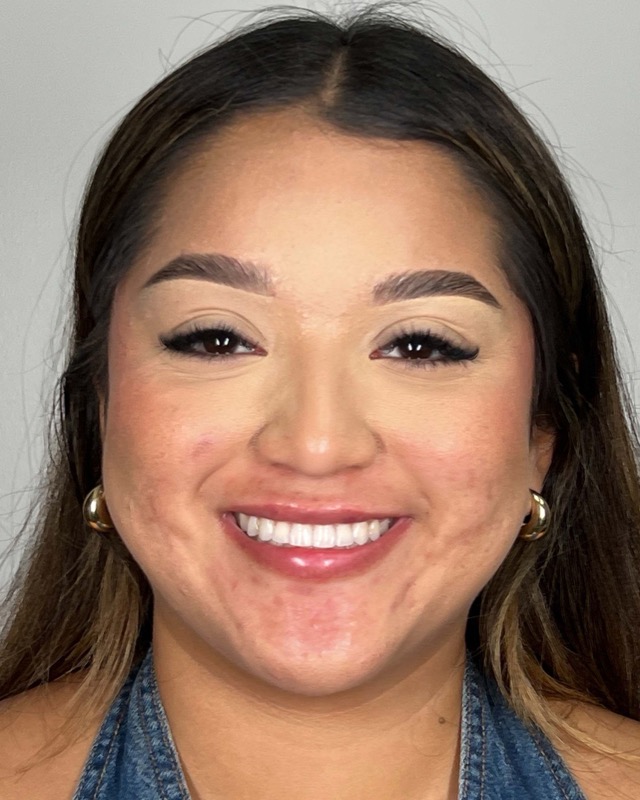 Juvederm Before & After Image