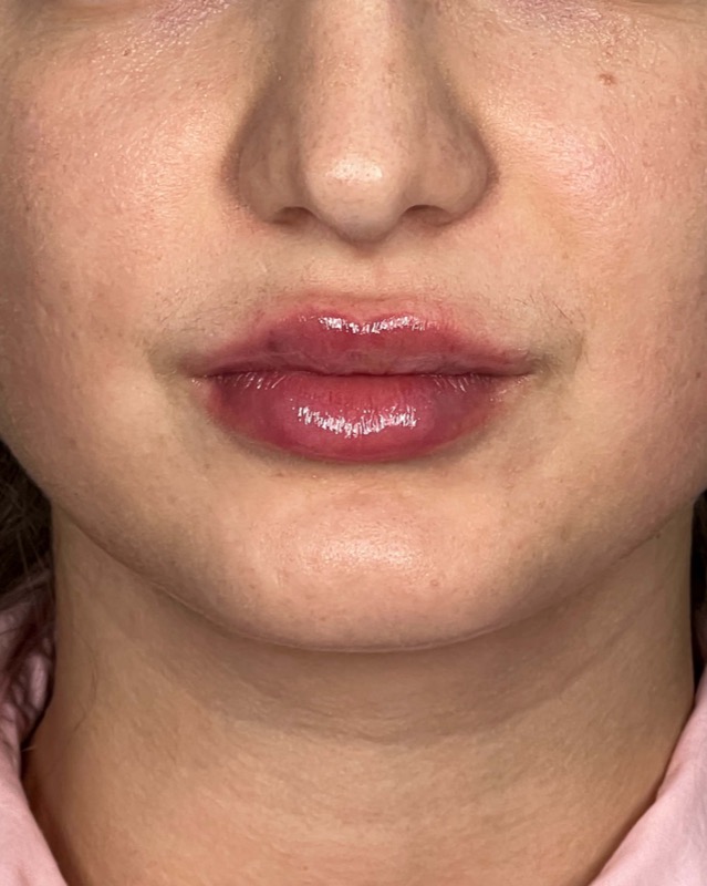 Juvederm Before & After Image