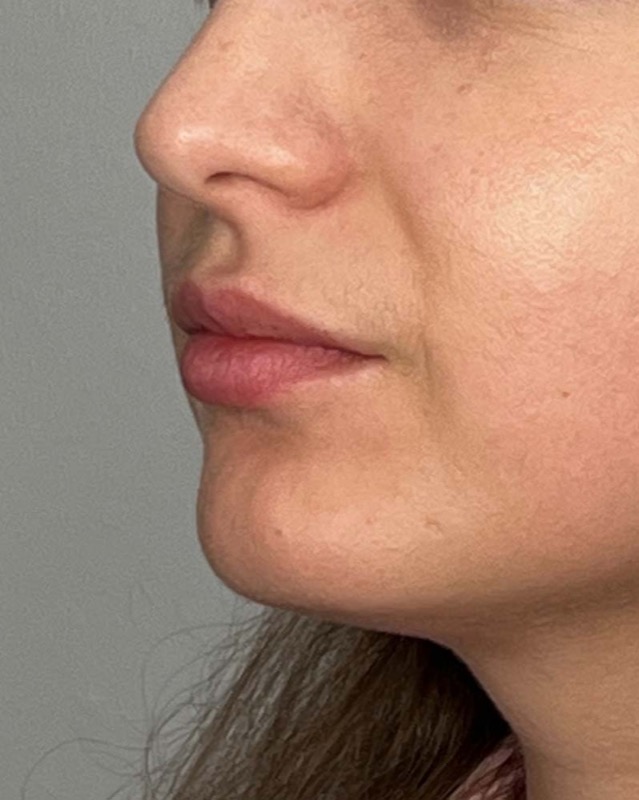 Juvederm Before & After Image