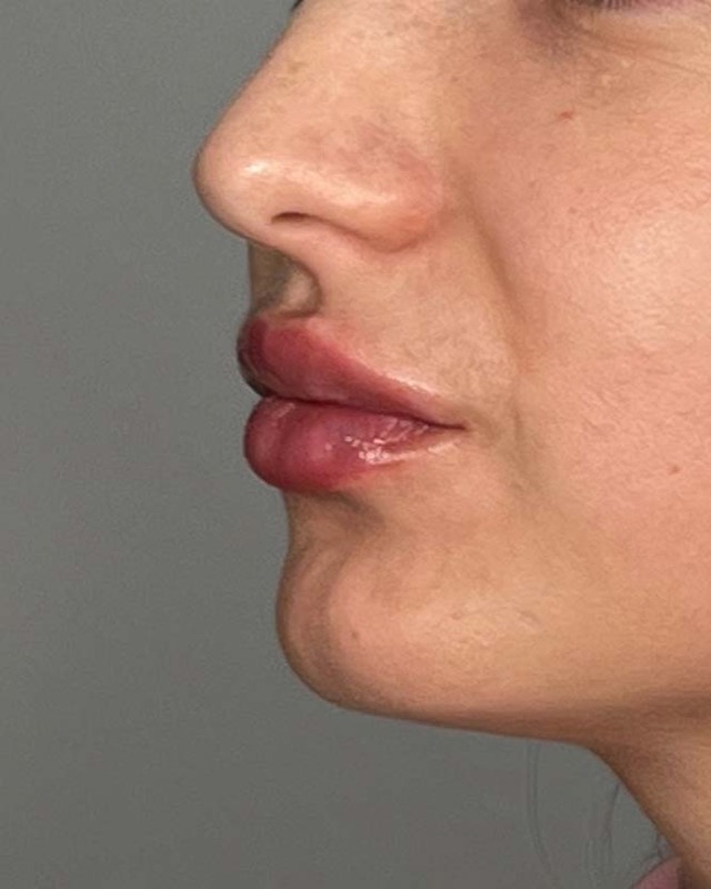 Juvederm Before & After Image