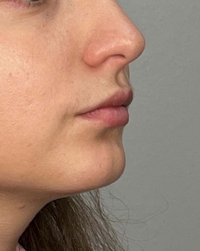 Juvederm Before & After Image