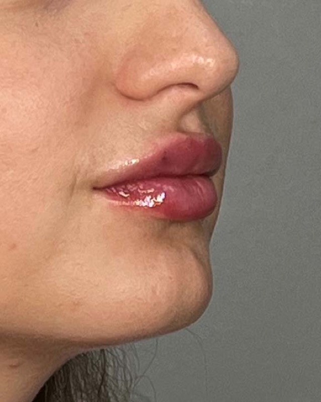Juvederm Before & After Image