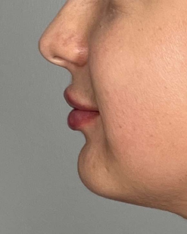 Juvederm Before & After Image