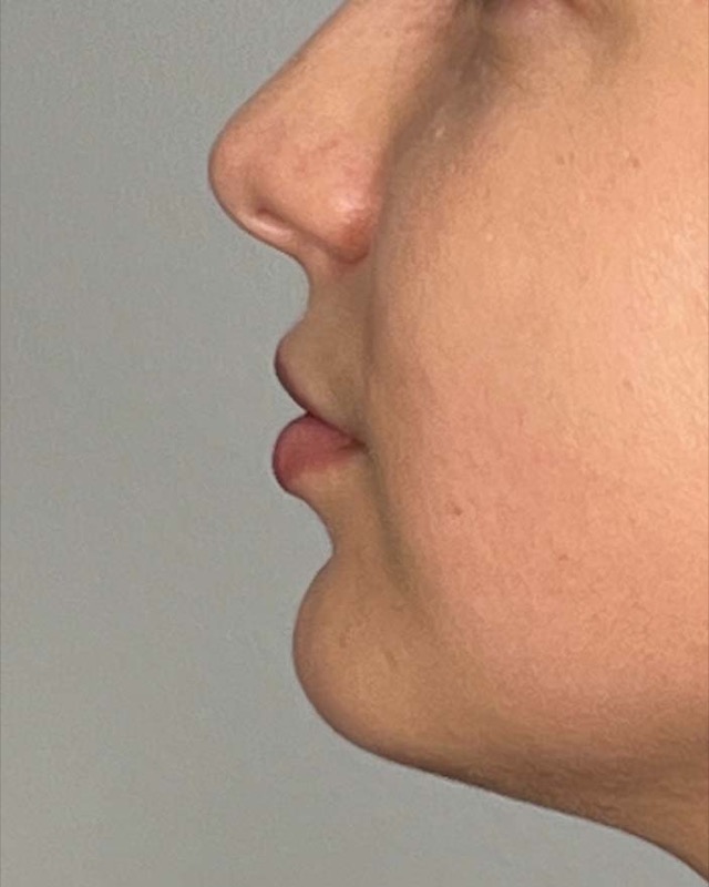 Juvederm Before & After Image