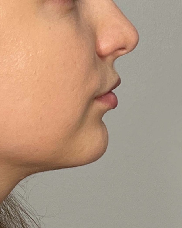 Juvederm Before & After Image