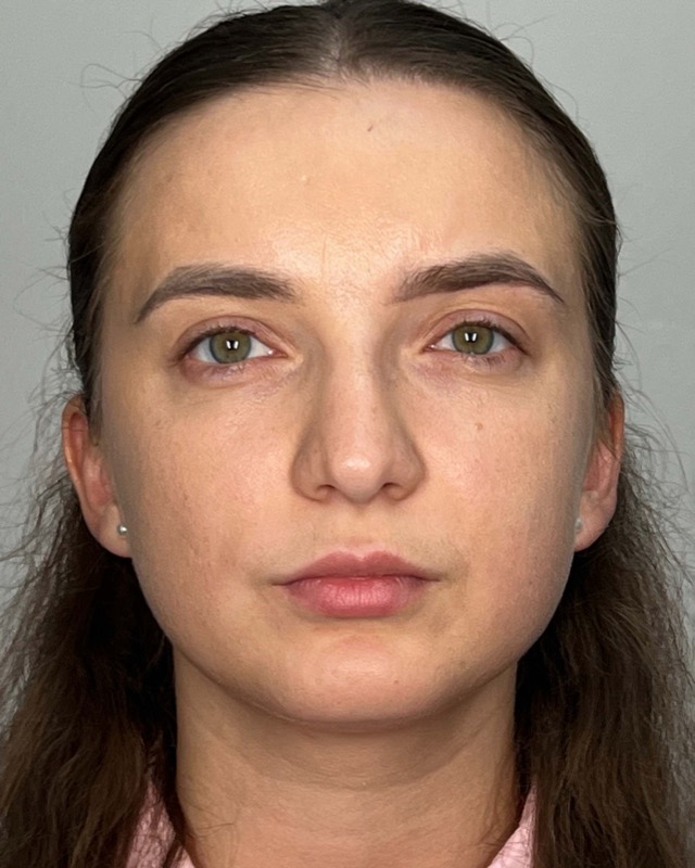 Juvederm Before & After Image