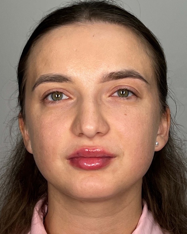 Juvederm Before & After Image