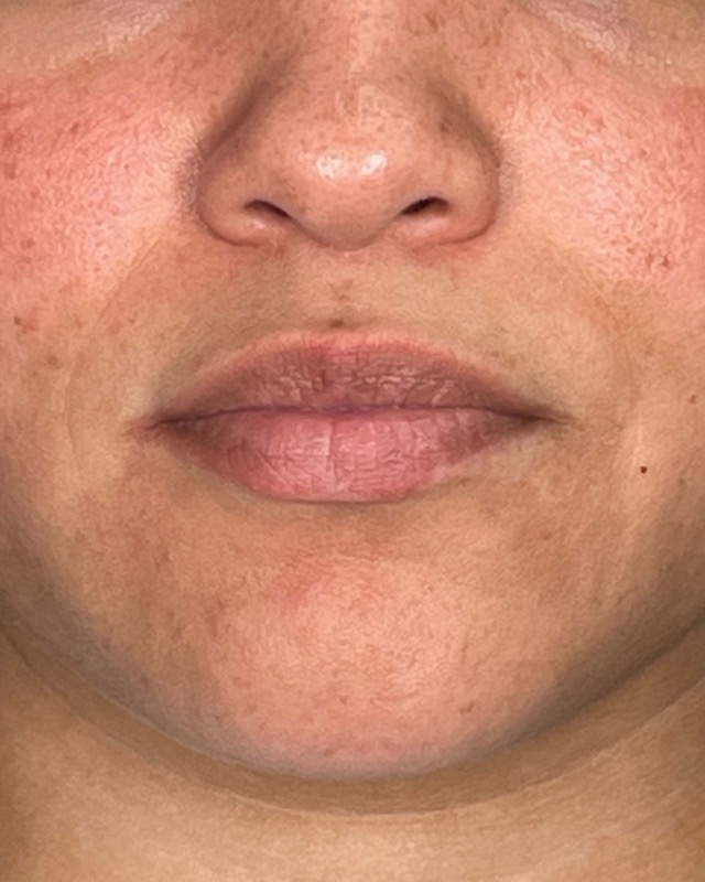 Juvederm Before & After Image